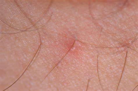 What Are Chiggers And How Do I Get Rid Of Them