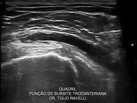 Interven O Guiada Pelo Ultrassom Pun O E Infiltra O De Bursite