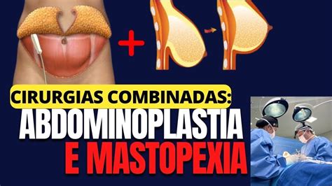 MASTOPEXIA E ABDOMINOPLASTIA POSSO FAZER AS DUAS CIRURGIAS JUNTAS Dr