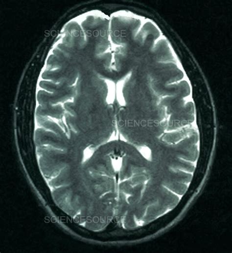 Photograph Mri Showing Arachnoid Cyst Science Source Images