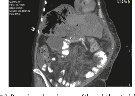 Figure 2 From A Rare Case Of Septic Shock Secondary To Emphysematous