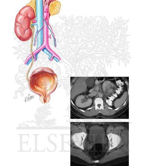 Anomalies in Number of Kidneys: Unilateral Renal Agenesis