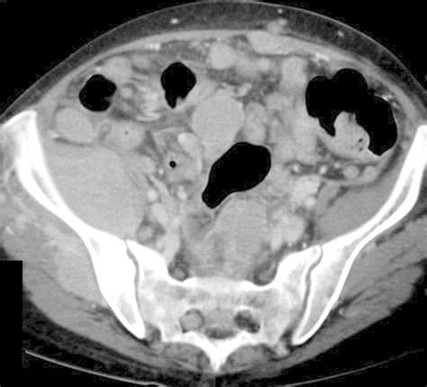 Primary Neoplasms Of Peritoneal And Sub Peritoneal Origin Ct Findings Radiographics