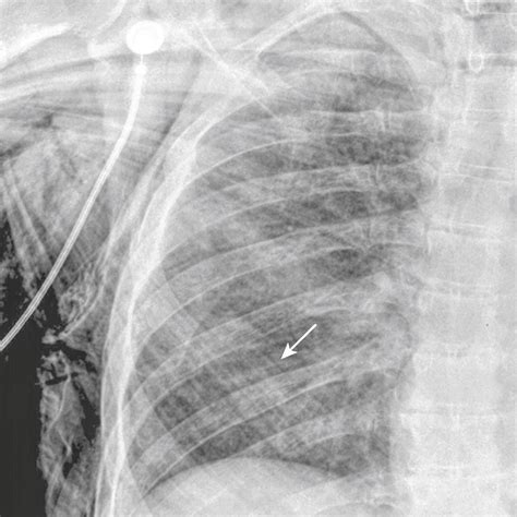 Recognizing The Imaging Findings Of Trauma To The Chest Clinical Tree