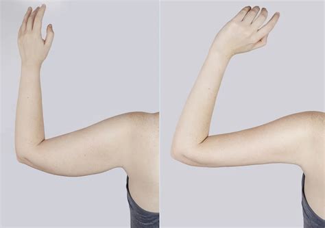 Day By Day Arm Liposuction Recovery What To Expect