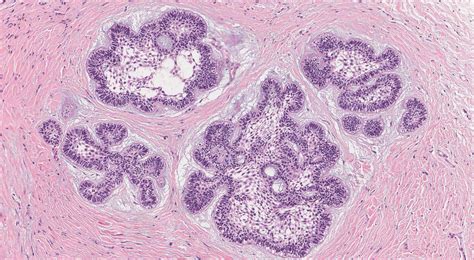 Plexiform Ameloblastoma Histology