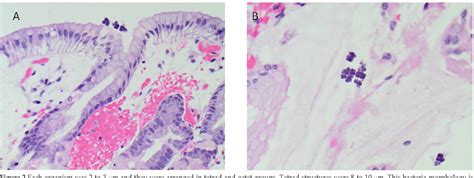 Table From Sarcina Ventricularis Complicating A Patient Status Post