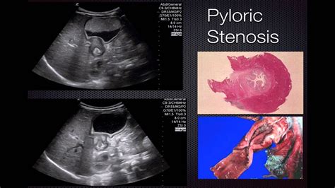 Ultrasond in Pathology - Pyloric Stenosis - YouTube