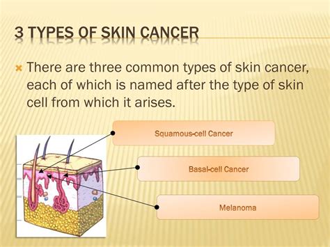 Types Of Skin Cancer DrBeckmann