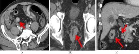 Ct Scan Anus Colon Telegraph