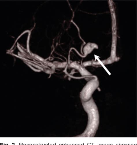 Figure From Traumatic Anterior Ethmoidal Artery Pseudoaneurysm With