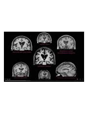 Dementia Brain Scans I.png - | Course Hero