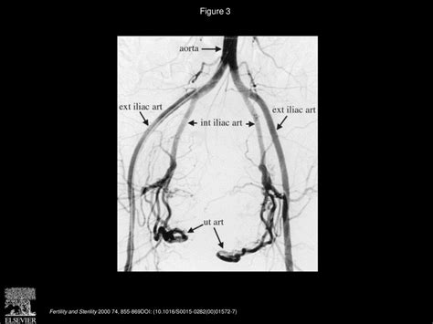 Uterine Artery Embolization For Symptomatic Uterine Myomas Ppt Download