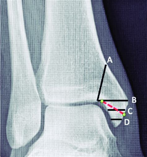 Medial Malleolus Fracture Lines Classified By Herscovici Types A B C Download Scientific