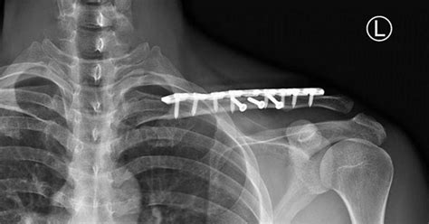 Elbow And Shoulder Fractures Dislocations Thames Shoulder Elbow