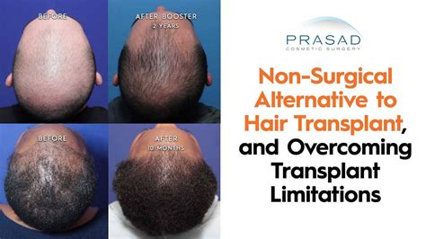 Effective Non-Surgical Hair Transplant Alternatives