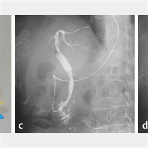 Problems In Umidas Stent Migration Into The Common Bile Duct Arrow