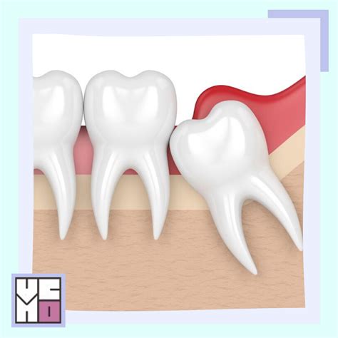 El Tercer Molar O Muela De Juicio Y Sus Complicaciones Asociadas