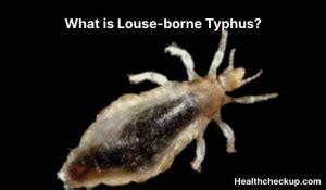 Louse Borne Typhus Symptoms Diagnosis Treatment Prevention