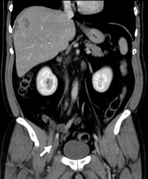 Liver Atlas: Diagnosis: Fascioliasis