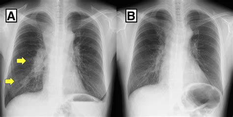 Chest X Rays Before And After Chemotherapy Comparison Of Chest X Rays