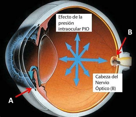 Qué Debo Saber Del Glaucoma Área Oftalmológica