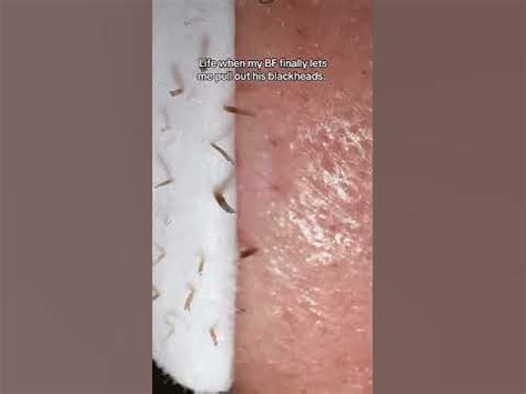 5 Unbelievable Blackhead Removal 2024 Hacks You Need to Try NOW! - x41egfj
