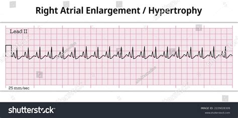 52 Right Atrial Enlargement Images, Stock Photos, 3D objects, & Vectors ...