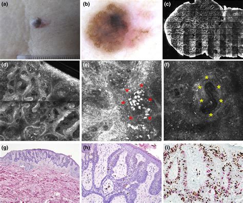 Clinical Picture Of The Lesion Slightly Raised Papule With Asymmetry