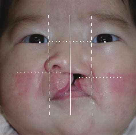 The Unilateral Complete Cleft Lip Nasal Deformity Of A Representative