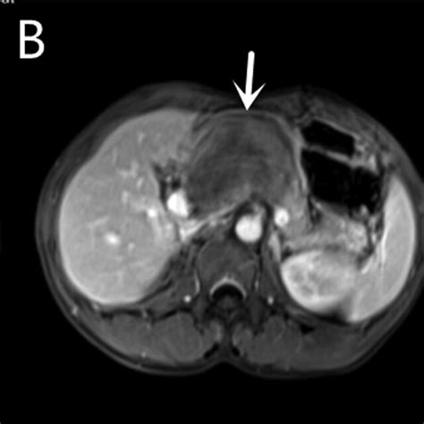 Contrast Enhanced Magnetic Resonance Mr Of A Mass On The Pancreatic