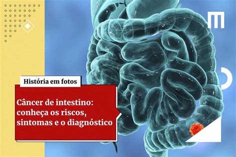 Câncer Intestino Estágio 1 Tempo De Vida - Médico alerta que anemia pode ser o 1º sinal do câncer de intestino