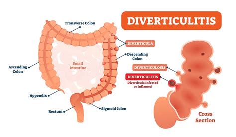 What Causes Pain In Lower Left Abdomen? - Left Side Pains