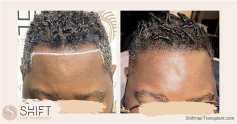 Afro Hair Transplant In Turkey Before And After Shift Hair Transplant In Istanbul 30 Shift