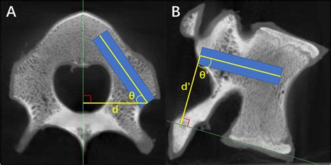 Measurement Of Pedicle Screw Planning Trajectory A Axial View Of The