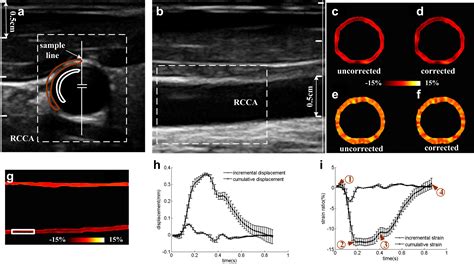 Non Invasive Vascular Radialcircumferential Strain Imaging And Wall