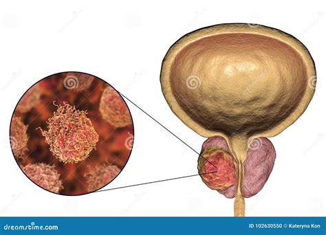 Prostate Cancer Symptoms Causes Diagnostics Flat Icons Set Vector