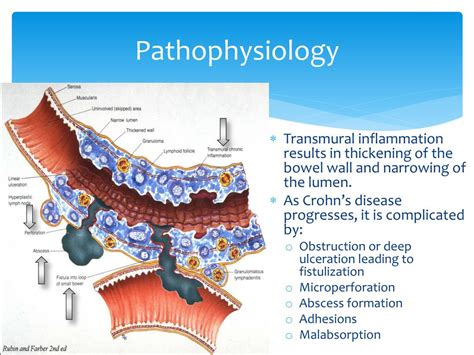 Ppt Nutritional Management Of Crohn’s Disease Powerpoint Presentation Id 3129584