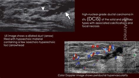 Breast Duct Ectasia Us Mammogram Mri