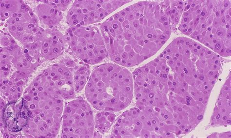 10.Liver (12) Hepatocellular carcinoma|Pathology Core Pictures