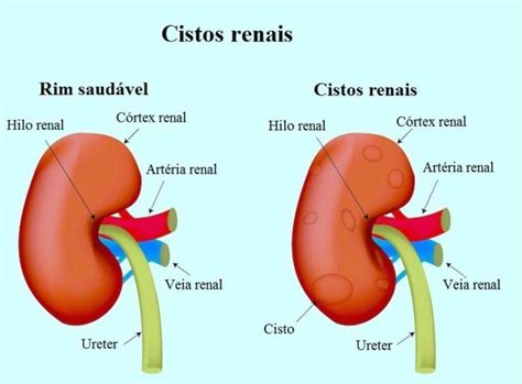 Cisto No Rim O Que Pode Ser - Nódulos e Cistos nos Rins: O Que Você Precisa Saber para Cuidar da Sua ...