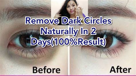 How To Remove Dark Circles Naturally In 2 Days100resultlive కాళ్ళ