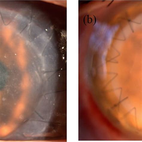 Recurrence Of Herpes Simplex Keratitis After Deep Anterior Lamellar Download Scientific Diagram