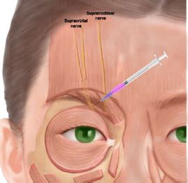 Supraorbital Nerve Block - NASHVILLE NEUROSCIENCE GROUP