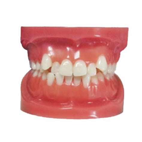 Denture typodont - Angle Class I - Creative Dental - dental care