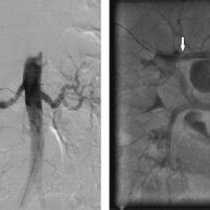 Aortografia Por Subtra O Digital E Arteriografia Renal Final Ap S