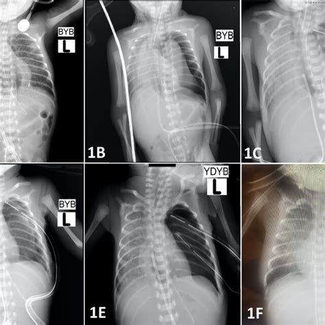 A Initial X Ray Showing Pneumomediastinum B Left Pneumothorax And