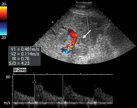 Doppler Ultrasound Findings In The Hepatic Artery Shortly After Liver