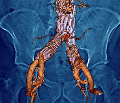 Stent In The Abdominal Aorta Photograph by Zephyr/science Photo Library