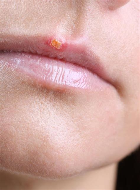 What Are Different Types Of Mouth Sores With Pictures